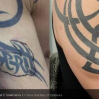 Arm Tattoo Removal before and after1 